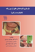 بازسازی تاج دندان های از بین رفته  انواع پست و کور